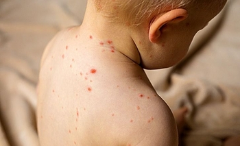 Imagen de la nota: Sarampión: recomendaciones ante el alerta epidemiológica