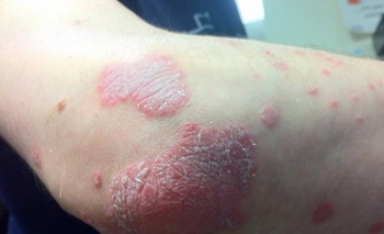 Imagen de la nota: La Psoriasis cómo enfrentarla y no excluirse