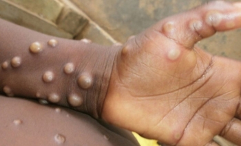 Imagen de la nota: Cómo se contagia la viruela del mono