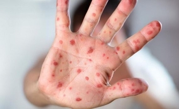 Imagen de la nota: Alerta epidemiológico por un caso de sarampión en la Provincia