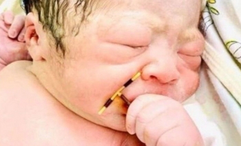 Imagen de la nota: Un bebe nació con el DIU de la mamá en la mano