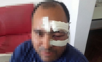 Así quedó el rostro de un policía tras los incidentes en barrio Matadero Imagen de la nota: Así quedó el rostro de un policía tras los incidentes en barrio Matadero