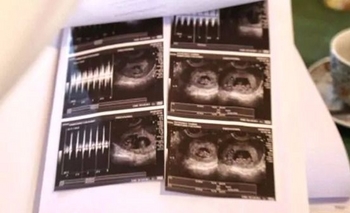 El olavarriense que será padre de mellizos y gemelos a la vez Imagen de la nota: El olavarriense que será padre de mellizos y gemelos a la vez