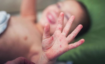 Imagen de la nota: Alerta por dos nuevos casos de sarampión en la Provincia