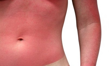 Imagen de la nota: Prevención Cáncer de Piel: Cuidala, es la única que tenés