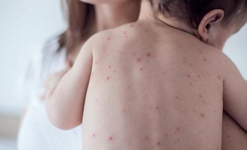 Imagen de la nota: Hay un fallecido y 118 casos de sarampión en la Provincia 