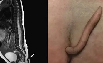 Imagen de la nota: Un bebé nació con una extraña cola de 6 centímetros